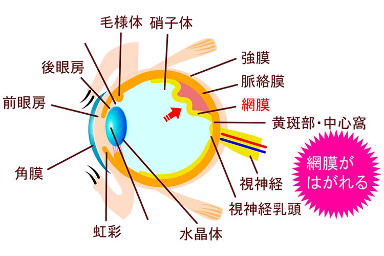 網膜剥離イメージ画像